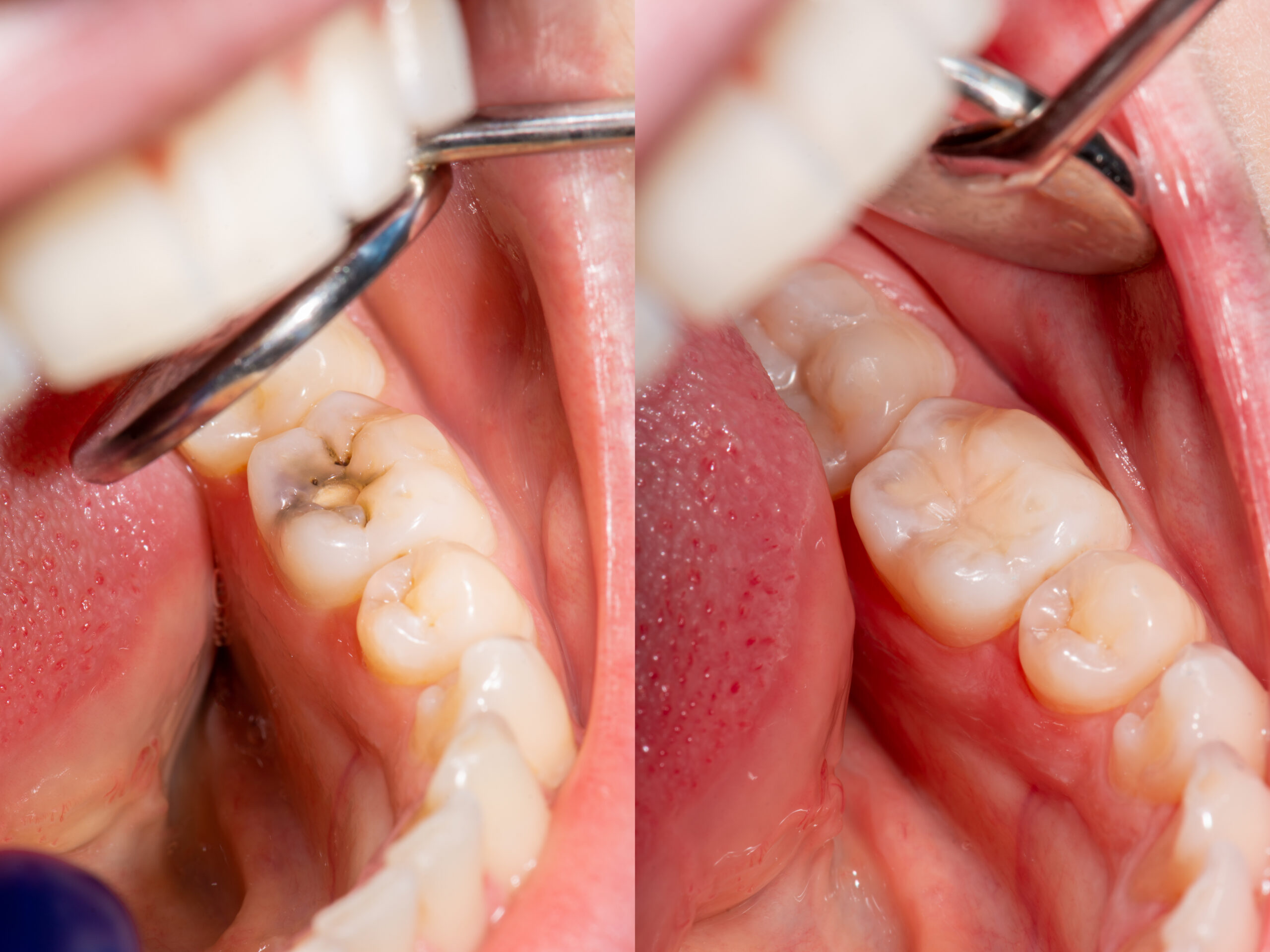 An image displaying dental fillng